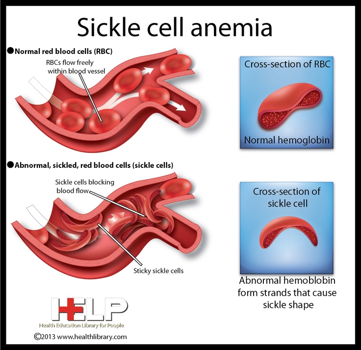 Symptoms Of Sickle Cell Anemia