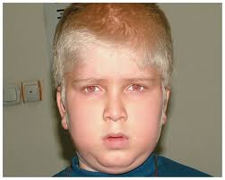 Albino Child